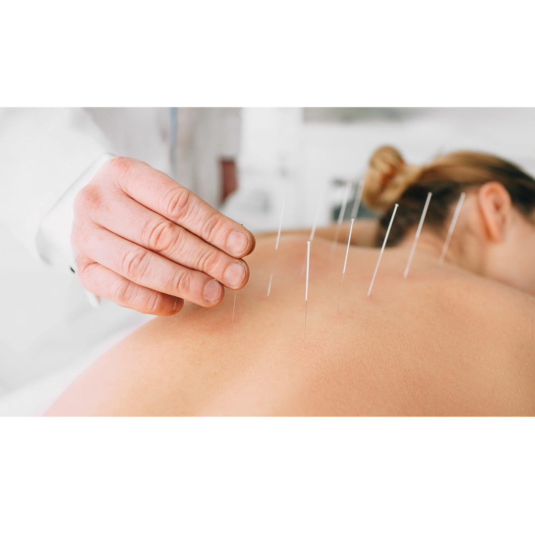 What Is Acupuncture? | YOU Massage Therapy